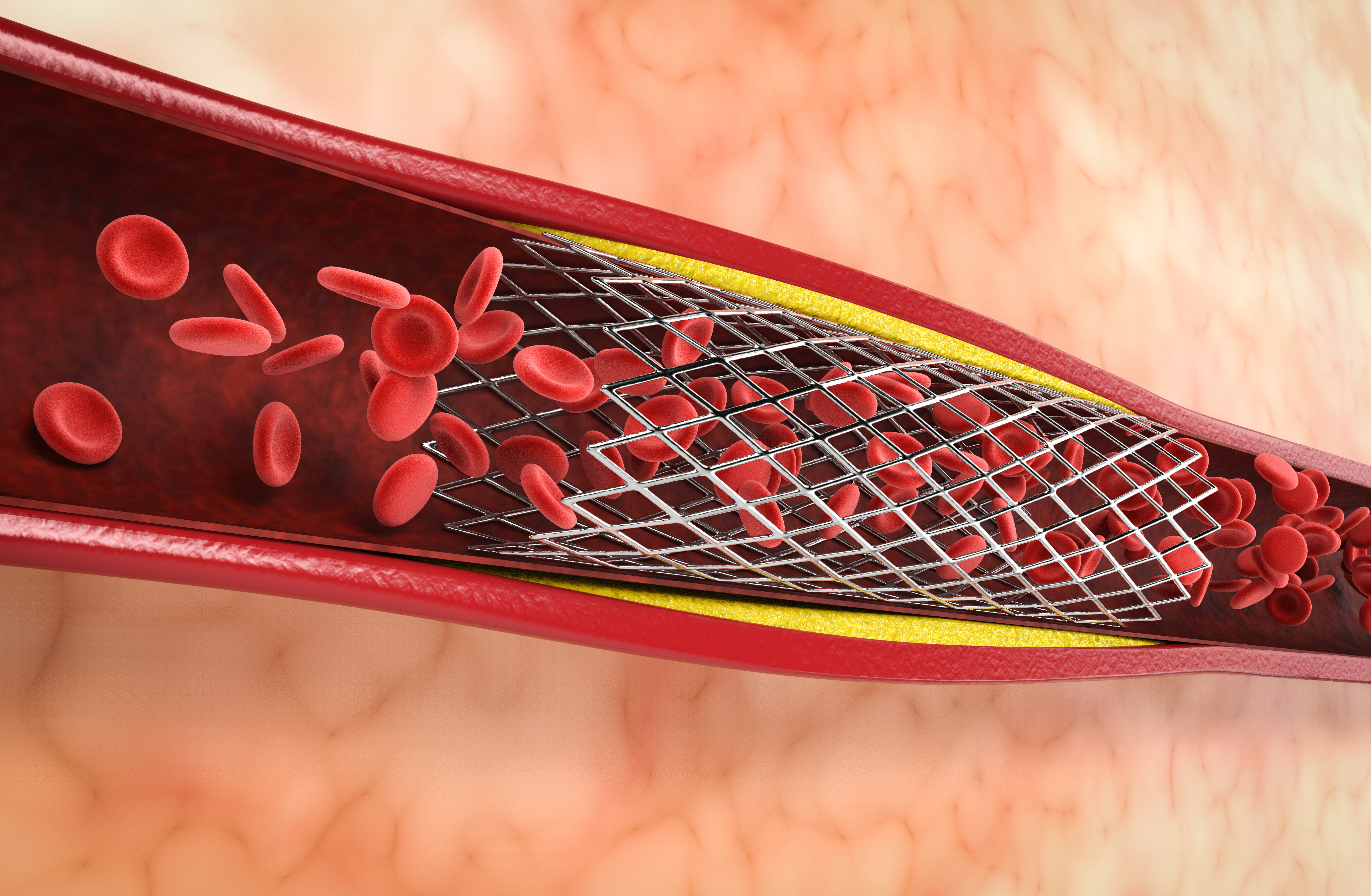 Illustration of a stent in place.