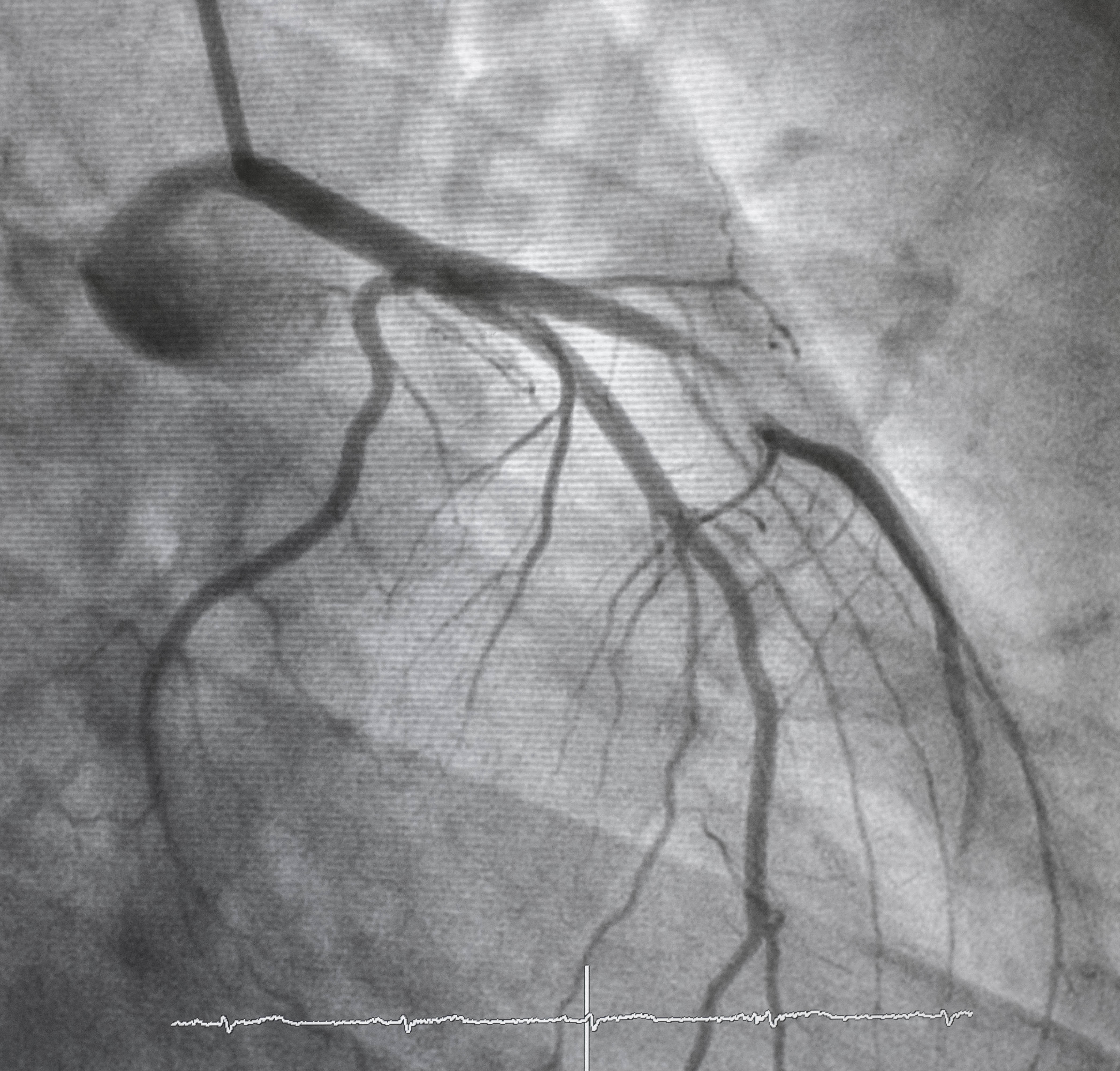 A black and white image of an angiogram.
