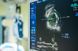 An intravascular ultrasound image is on a screen in a cath lab.