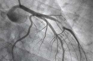 A black and white image angiography.