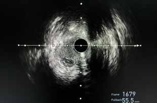 An ultrasound image of percutaneous coronary intervention