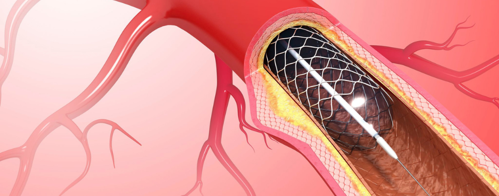 An illustration of a stent being placed by catheter.