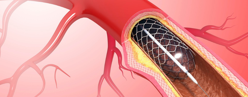 An illustration of a coronary stent.